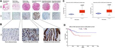 AK2 Promotes the Migration and Invasion of Lung Adenocarcinoma by Activating TGF-β/Smad Pathway In vitro and In vivo